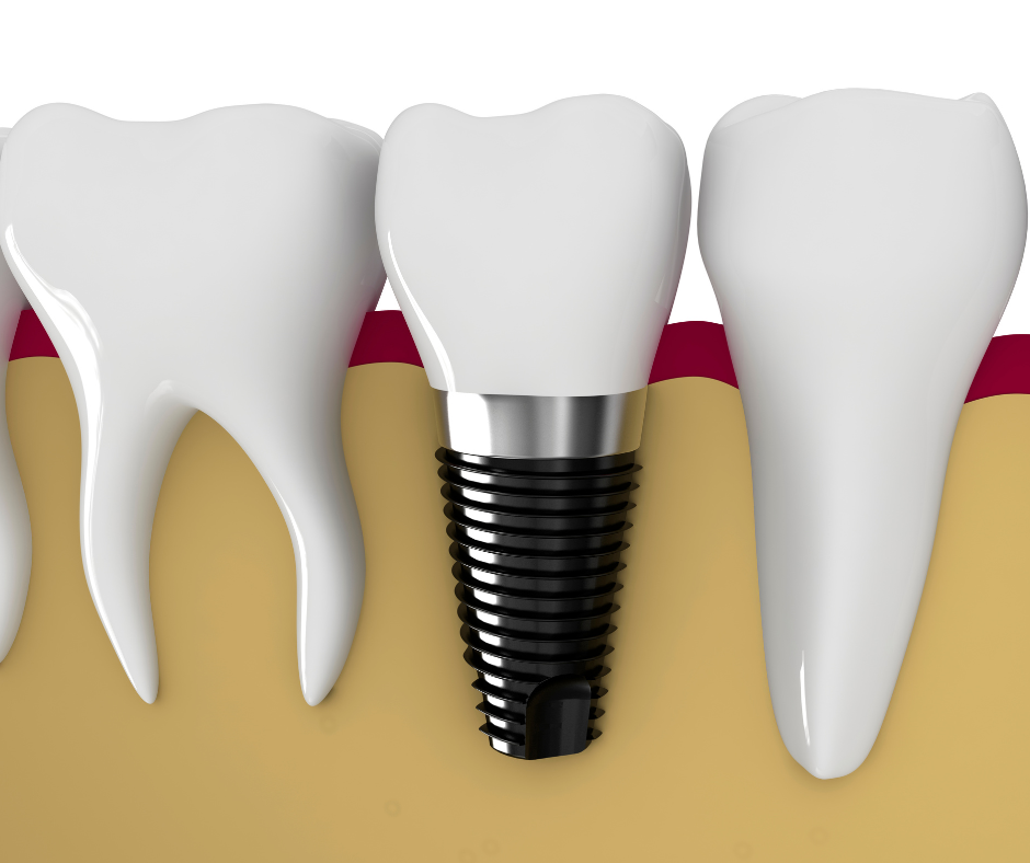 Dental Implants