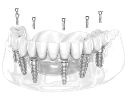 All-on-Four & Prosthetics